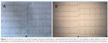 In myocarditis, ecg is an asset to find out abnormal heart rhythms. Peri Miocardite Durante Infezione Delle Vie Urinarie Da Escherichia Coli Giornale Italiano Di Cardiologia Organo Ufficiale Di Italian Federation Of Cardiology E Societa Italiana Di Chirurgia Cardiaca