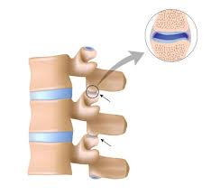 We did not find results for: Wirbelsaulenarthrose Facettengelenksarthrose Verursacht Ruckenschmerzen Gelenk Klinik De