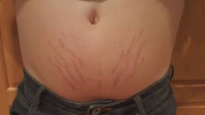 For women, stretch marks are often associated with puberty and pregnancy, says haus. Health Check Home Treatment For Stretch Marks Wjar