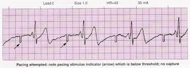 Image result for Transcutaneous Pacing