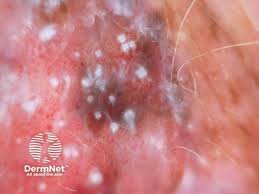 Image result for Vulvar Cancer