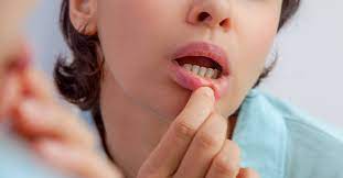 Canker sores most of the time go away without any treatment. Canker Sore Vs Cold Sore What S The Difference