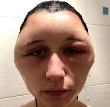 Most contact dermatitis from a hair dye allergy is. Photos Woman Whose Scalp Doubles In Size After Using Hair Dye Warns Against Danger Of Ppd In Home Hair Dye Kits