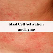 Lymeqa offer good through 11:59 pm est on monday, november 13, or while supplies last. Lyme Sci The Agony Of Mast Cell Activation Syndrome Mcas