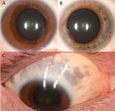 Image result for melanosis sclera