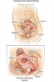 Uterine Fibroids Uterine Fibroids Fibroids Fibroid Uterus