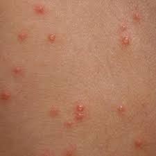 Savesave cacar air.pptx for later. Jom Bantu Demam Campak Vs Cacar Air Chicken Pox Demam Facebook