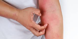 Anda bisa memanfaatkannya untuk membuat situs web anda sendiri dengan. Dermatitis Jenis Penyebab Pencegahan Hingga Cara Mengatasinya Halaman All Kompas Com