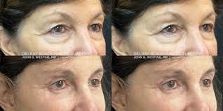 John G. Westine, MD, Board Certified Facial Plastic Surgeon