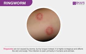 Does hand sanitizer kill ringworm from i.pinimg.com so, if you are looking for the best hand sanitizer. What Is A Ringworm Causes Types Symptoms Treatment
