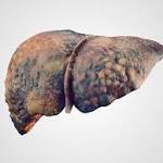  A method to identify splicing-based biomarkers for liver cancer now gets developed by the scientists