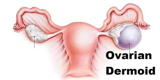 Image result for Cyst