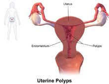 Uterine polyps, also called endometrial polyps, are small, soft growths on the inside of a woman's uterus, or womb. Endometrial Polyp Wikipedia