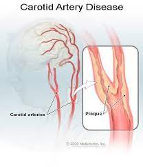 It supplies structures present in the cranial cavity and orbit. Carotid Artery Disease Symptoms Treatment Life Expectancy Causes
