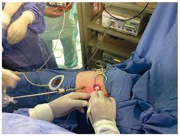 Scielo Brasil Video Assisted Thoracoscopic Implantation Of A Diaphragmatic Pacemaker In A Child With Tetraplegia Indications Technique And Results Video Assisted Thoracoscopic Implantation Of A Diaphragmatic Pacemaker In A Child With Tetraplegia