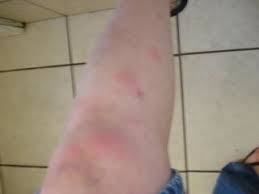 A skin lesion is a part of the skin that has an abnormal appearance compared to the skin around it. Vasculitis Images Vasculitis Uk