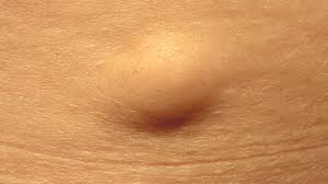 Ear cancer is a term used to describe a malignancy that develops in the cells that form the tissues of the outer ear, ear canal, middle ear, or inner ear. What Causes Lumps Behind The Ears