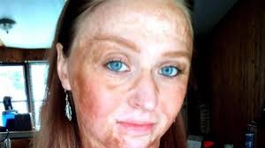 Una madre roció a su hija con gasolina para quitarle los piojos y le quemó  el 60% del cuerpo