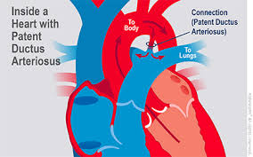 If one partner's needs aren't being met, it could be destructive for the whole relationship. Patent Ductus Arteriosus Pda For Parents Nemours Kidshealth