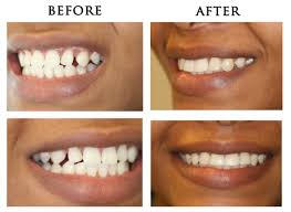 Maybe you would like to learn more about one of these? How To Fix Gap Teeth Fast Arxiusarquitectura