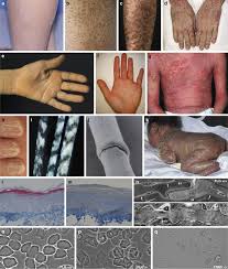Image result for Ichthyosis