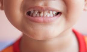 Articles Intercare Tooth Decay In Small Kids Tooth Decay Tooth Decay In Children Tooth Ache Relief
