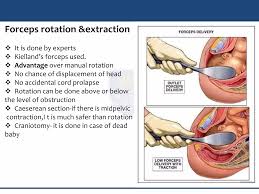 Image result for Manual Rotation in Occipitoposterior Presentation