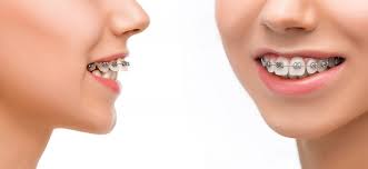 The cost to correct underbite without surgery using braces may be around $3,000 to $8,000, although braces are typically covered by dental insurance. Dental Solutions For Overbite Underbite Crooked Crowded Teeth