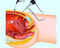 Most often this is on the ovaries, fallopian tubes, and tissue around the uterus and ovaries; Diagnosi E Cura Dell Endometriosi Seno Clinic