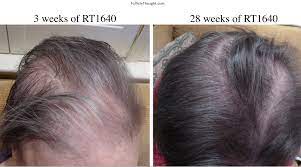 There is no cure for permanent hair loss because the hair follicles are no longer active. Permanent Chemotherapy Induced Alopecia Reversal Follicle Thought