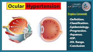 Image result for Intraocular Pressure
