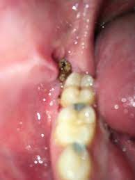 This time may vary depending on if the wisdom teeth were impacted in bone or in gum tissue. Hi Sorry This Might Be Discussing Forr Some But I M Really Worried I Got My Wisdom Teeth Removed 3 Days Ago And In The Holes The Wisdom Teeth Teeth Brown Stuff