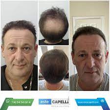 A cosa è dovuto questo fenomeno e quali sono i rischi quando si esce dall'europa? Perche Il Trapianto Capelli In Turchia Estecapelli