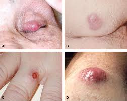 Image result for Merkel Cell Carcinoma