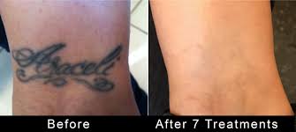 Tattoo removal can be first step in ensuring job search success. Tattoo Removal Van Nuys Tattooremovers Ink