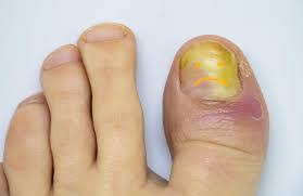 Image result for Yellow nail syndrome feet