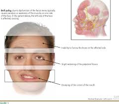 The cause of bell's palsy is not clear but most cases are probably due to a viral infection. Pdf Bell Palsy Clinical Examination And Management Semantic Scholar