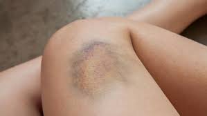 How long does it take for a bruise to go away? How To Get Rid Of Bruises Fast Best Tips And Tricks To Help Make Them Go Away Sooner Mirror Online