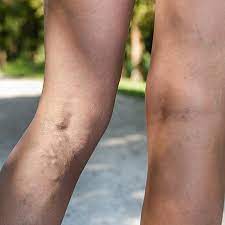 Are Spider Veins Anything To Worry About Memorial Hospital