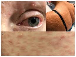 Syphilis is a very dangerous sexually transmitted infection, caused by a syphilis: Papulosquamous Eruption With Ocular Symptoms Caused By Syphilis Cmaj
