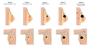 Image result for Breast Cancer Staging