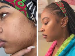 Just sharing something that helped me maybe it can help you too 💕…… After  having the twins, my hormones went CRAZY 😩🙈 My skin went from smooth to a  full-on battlefield overnight.