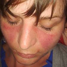 Image result for red rash face