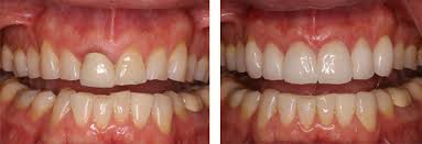 Another secret to having a better smile is to have a healthy set of teeth. Smile Gallery Family And Cosmetic Dentist In Neeham Ma And Boston Ma