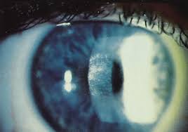 Crstoday | Unexpected Corneal Responses To Cxl