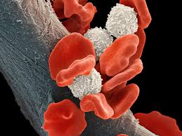 Image result for Leukemia