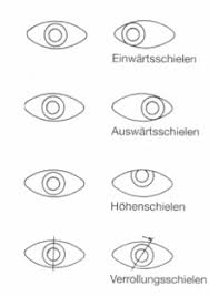 Schielen Wikipedia