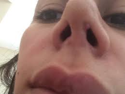 Granulomas are typically composed of macrophages, often fusing to form multinucleated. I Am One Month Post Rhinoplasty And Since The Third Week This Annoying Flesh Like Lump Appeared In My Left Nostril What Is It