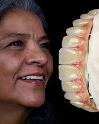 Toronto CrCo+ Zirconia + Nexco Gingiva #dentaltechnology #dentaltechnician  #exocad #theet #allonsix #implantedental #dentiphoto #dentaltech