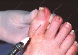 Image result for Toenail Removal